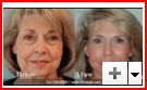 Facelift Houston Texas
