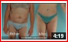 Houston Liposuction